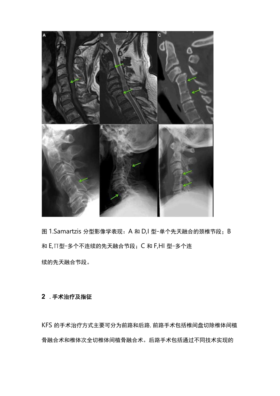 最新：Klippel-Feil综合征影像学分型指导对手术治疗的研究进展（全文）.docx_第2页