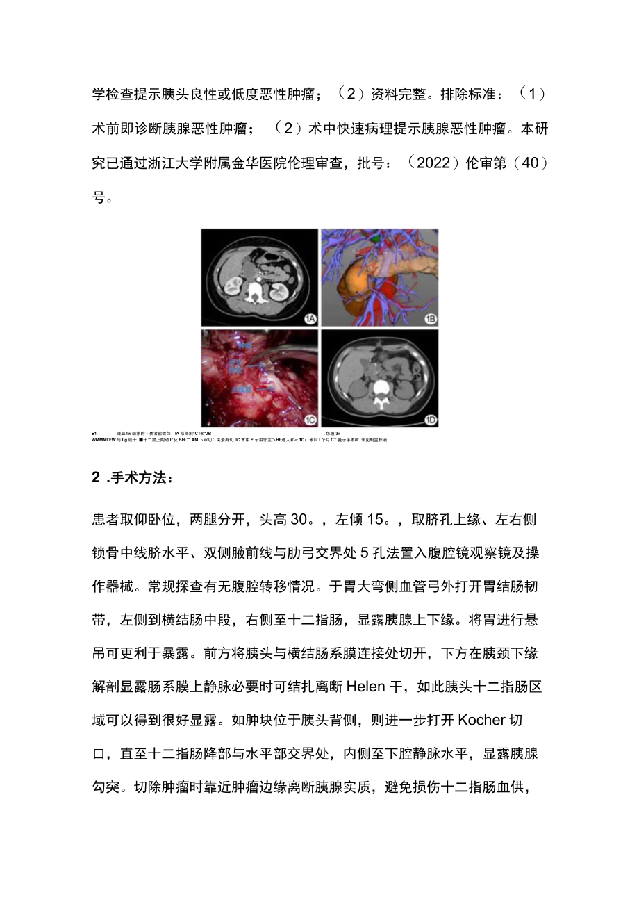 腹腔镜下胰头肿瘤局部切除（全文）.docx_第2页