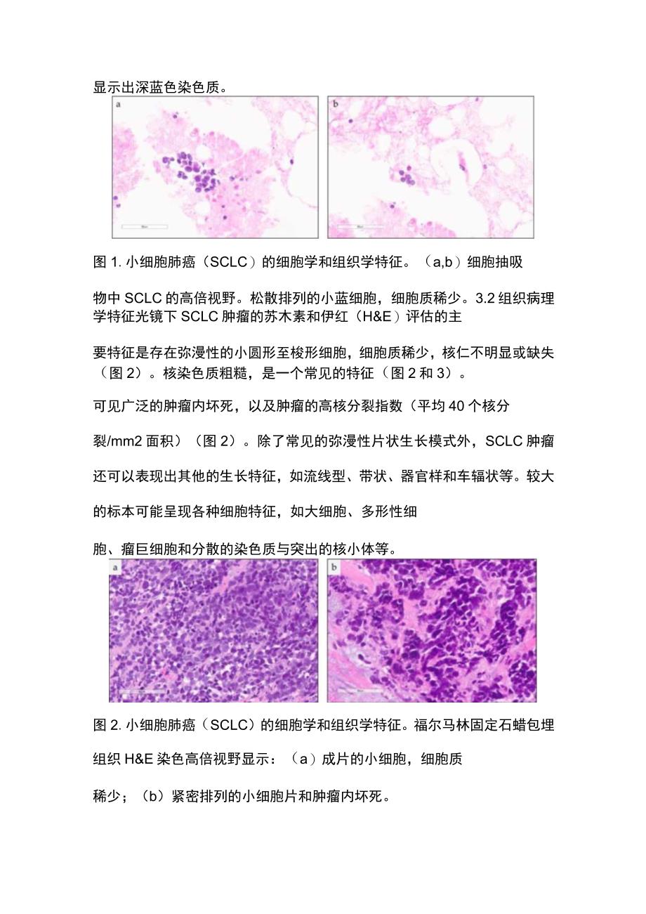 2023小细胞肺癌病理诊断要点.docx_第3页