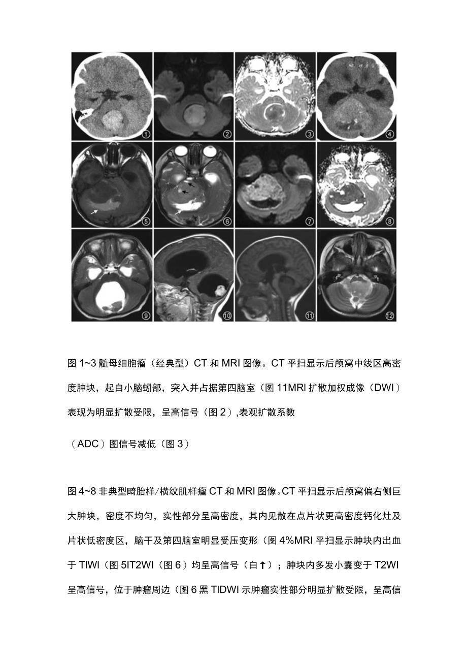 2023儿童后颅窝肿瘤的影像学诊断思路.docx_第3页