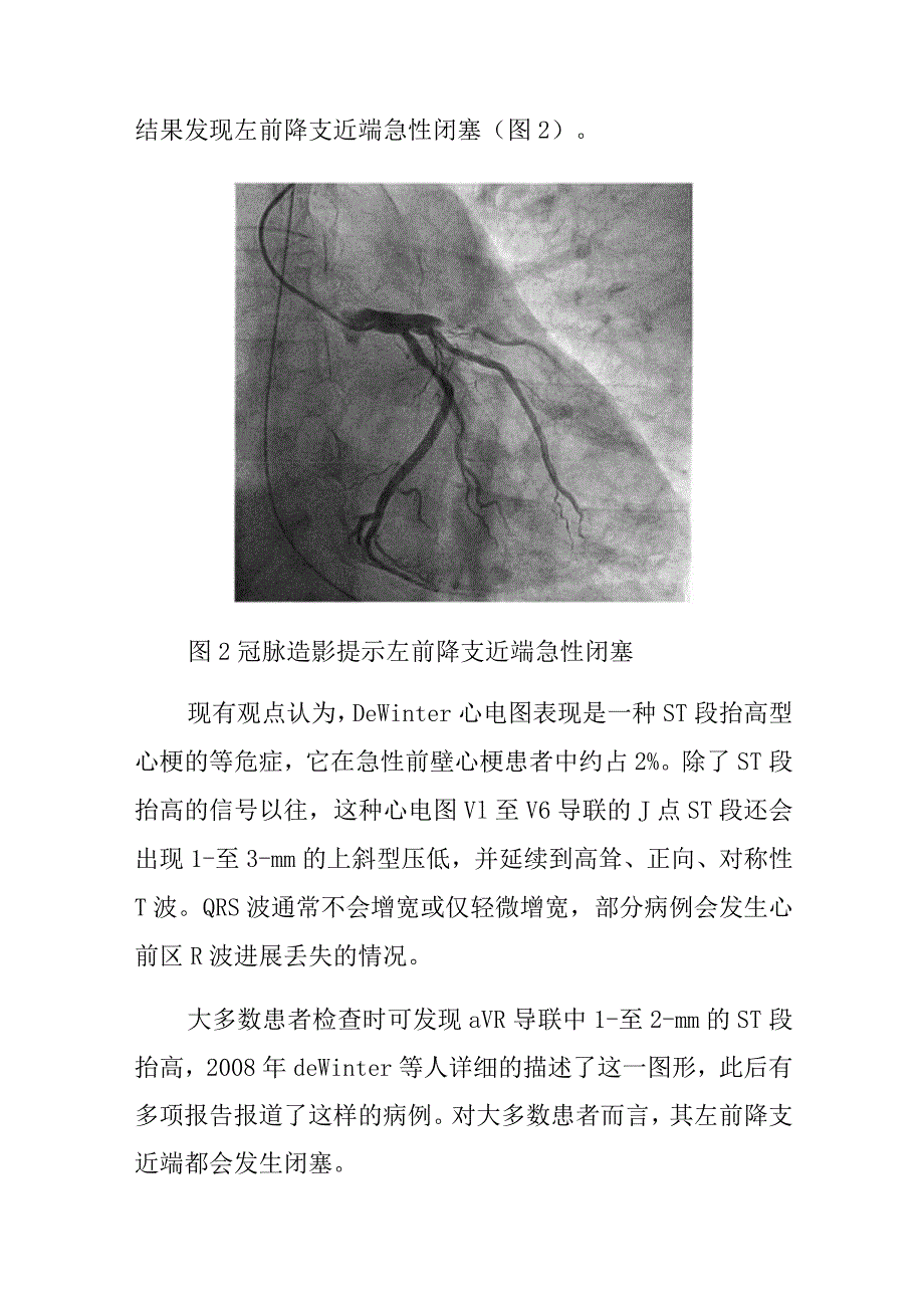 心电图室医师晋升副主任（主任）医师高级职称病例分析专题报告（罕见但却致命的De Winter综合征）.docx_第3页