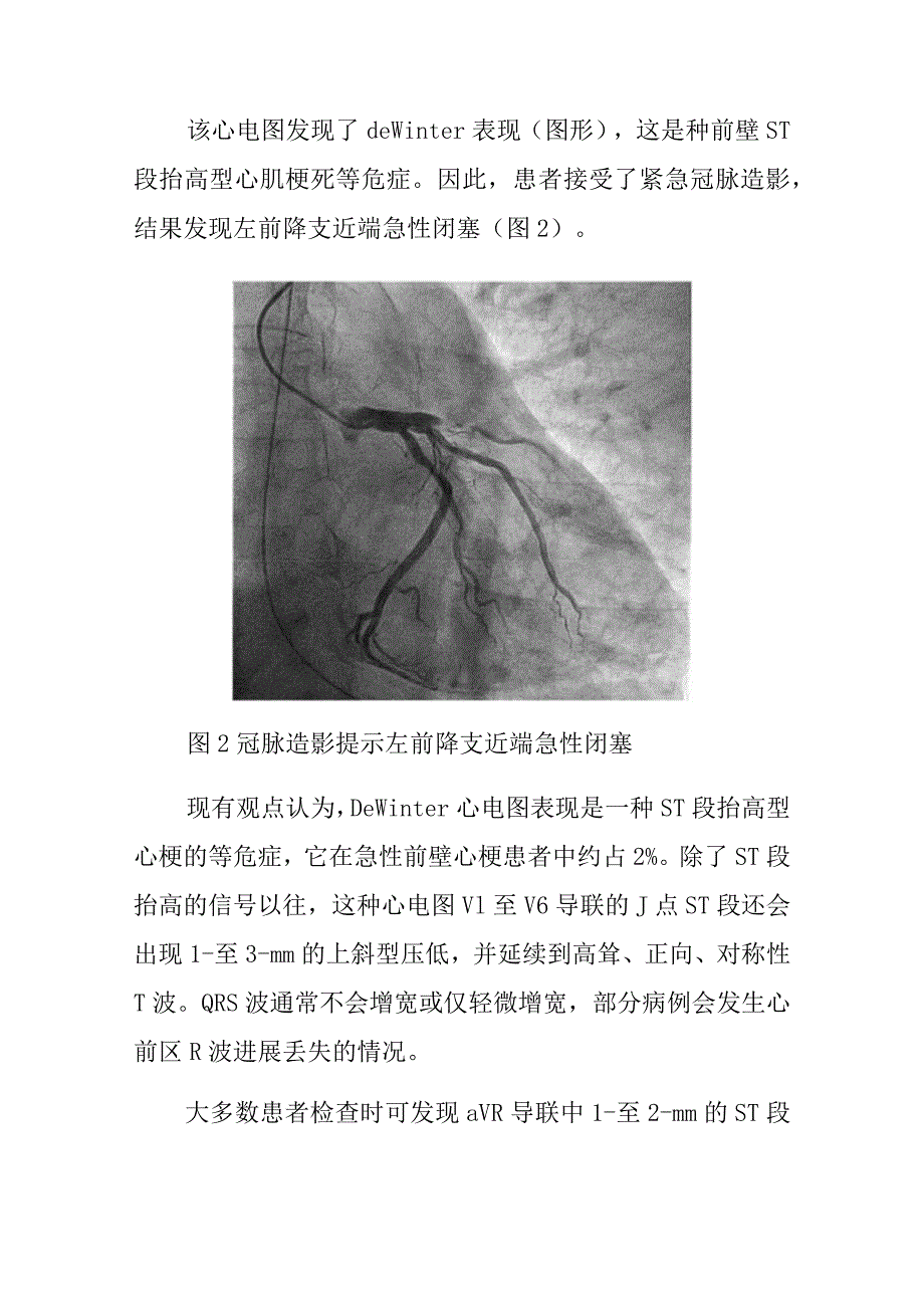 心电图医师晋升副主任（主任）医师高级职称病例分析专题报告（De Winter综合征病）.docx_第3页