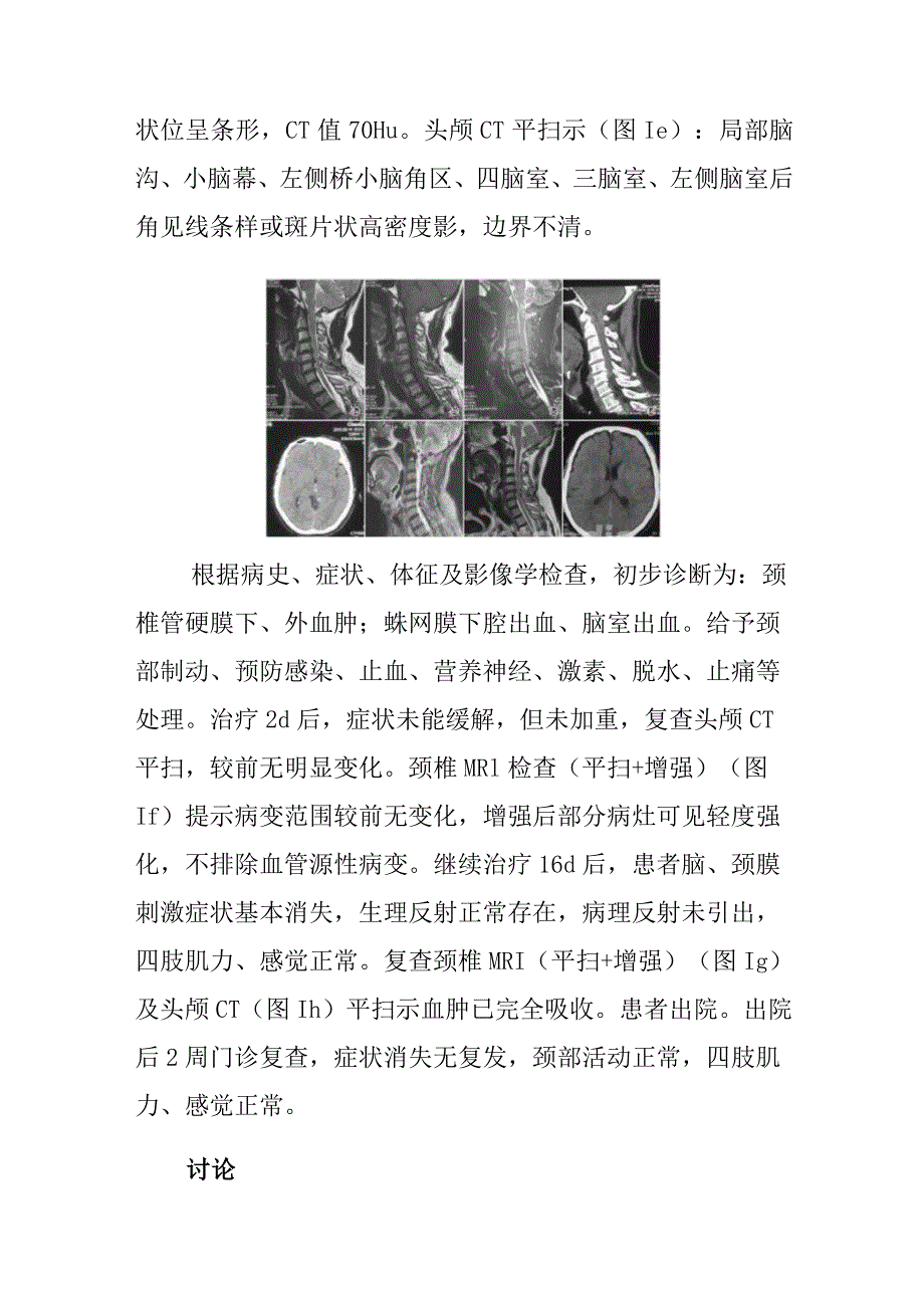 针灸科针刺致颈椎管硬膜下外血肿病例分析专题报告.docx_第2页