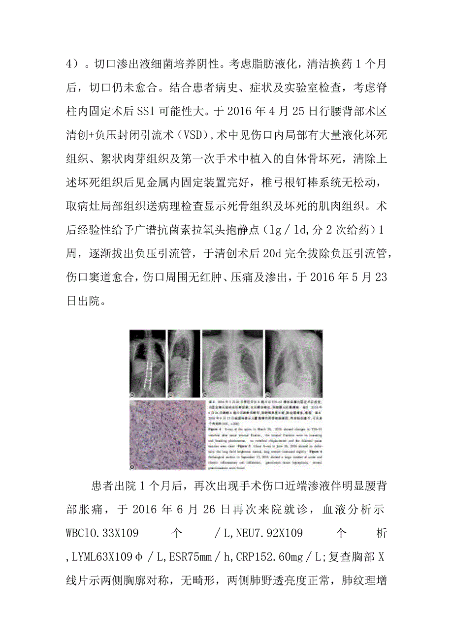 骨科脊柱内固定术后手术部位感染并脊柱结核诊疗分析专题报告.docx_第3页