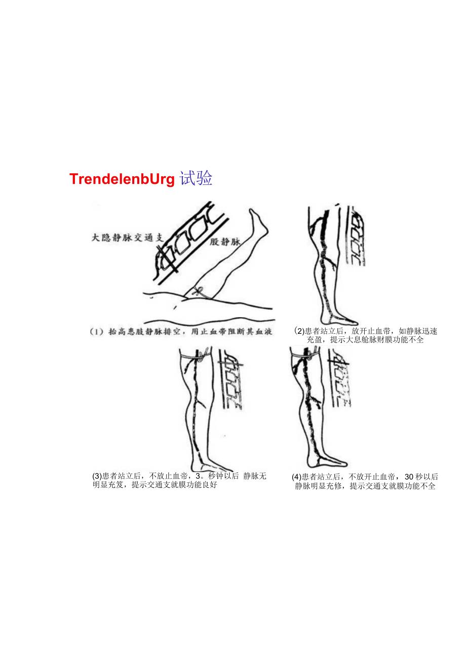 深静脉通常试验（Perthes试验也称踢腿试验）.docx_第3页