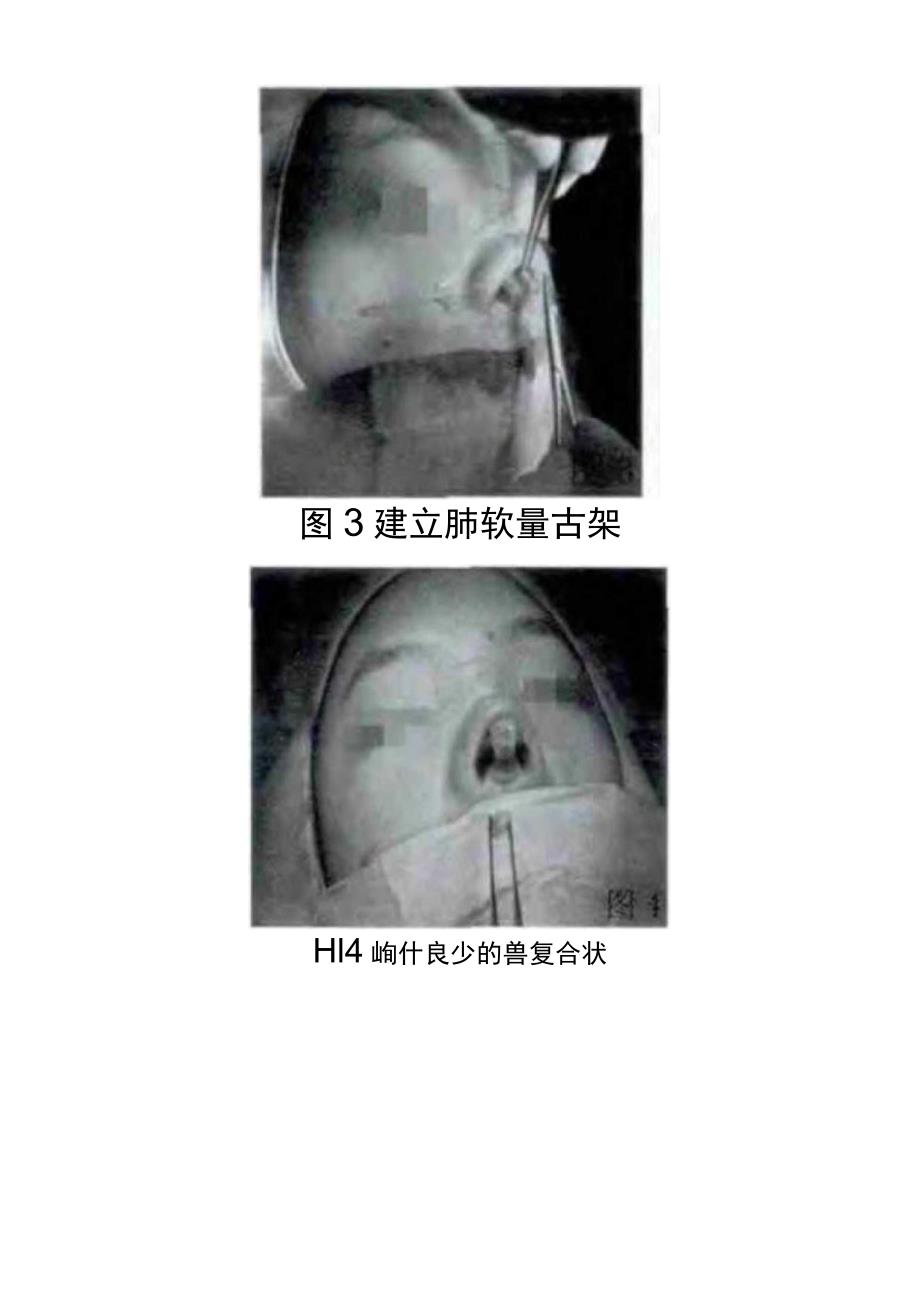 医美鼻整形肋软骨填充术基础临床护理知识.docx_第3页