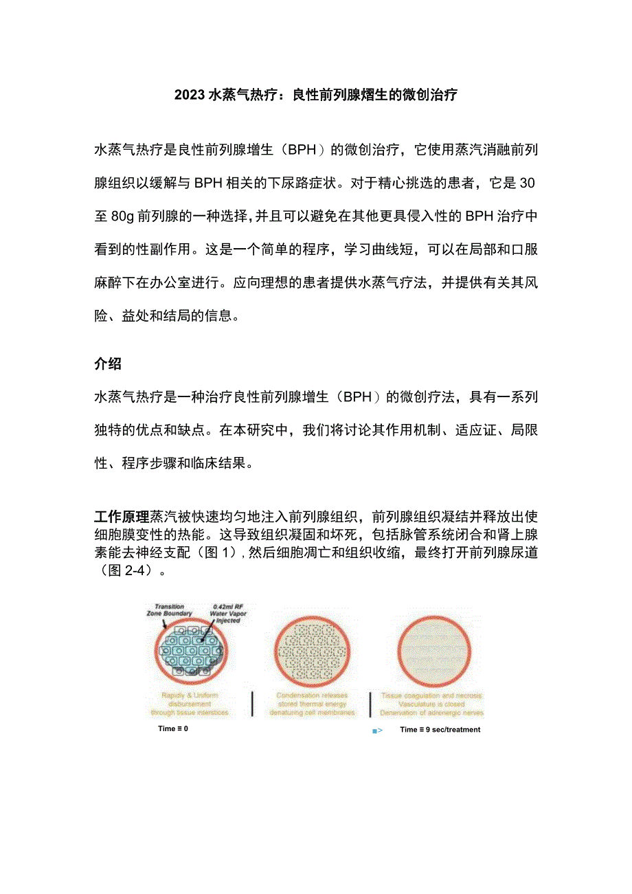 2023水蒸气热疗：良性前列腺增生的微创治疗.docx_第1页