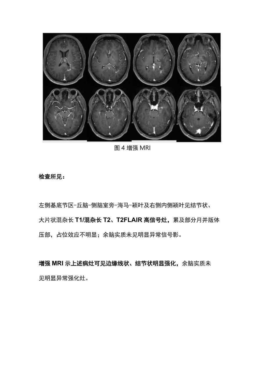 最新：脱髓鞘病变的诊治总结.docx_第3页