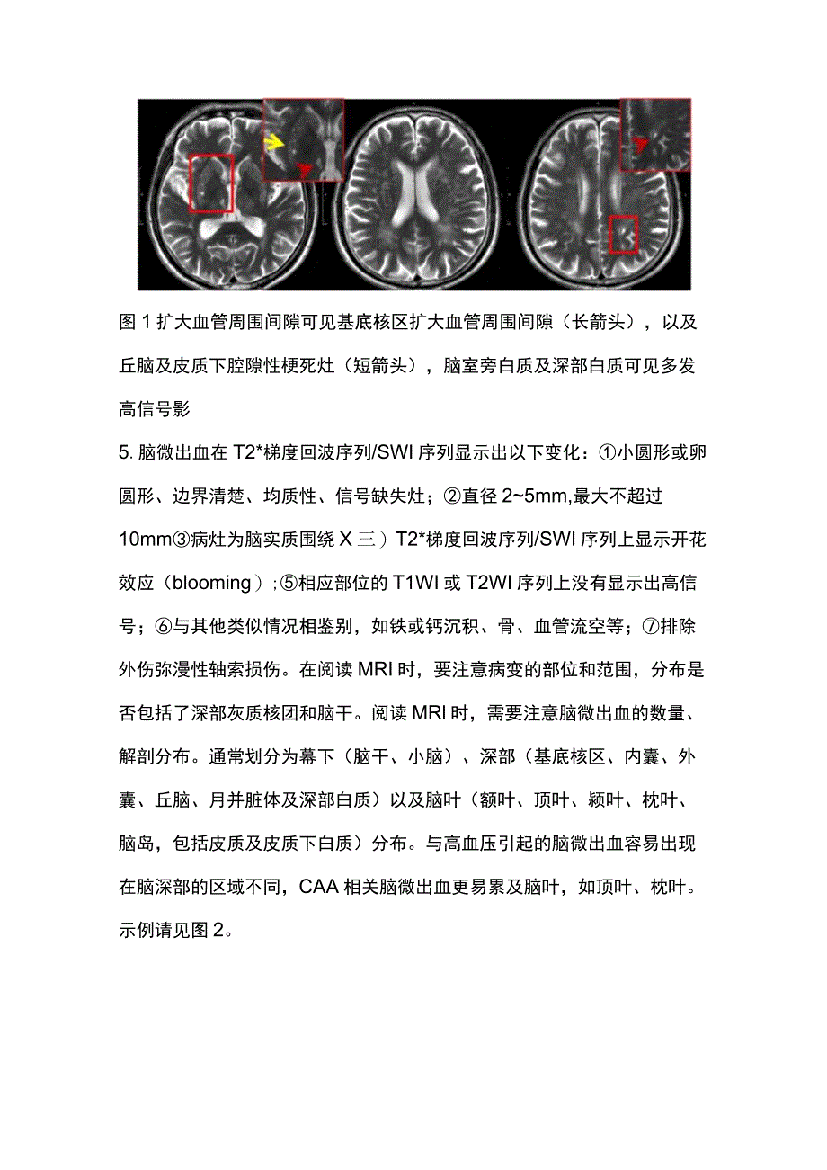 2023脑小血管病的诊疗要点及影像学评估.docx_第3页