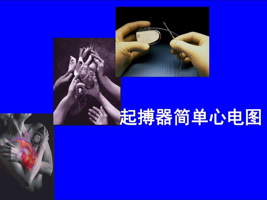 起搏器心电图1.ppt_第1页