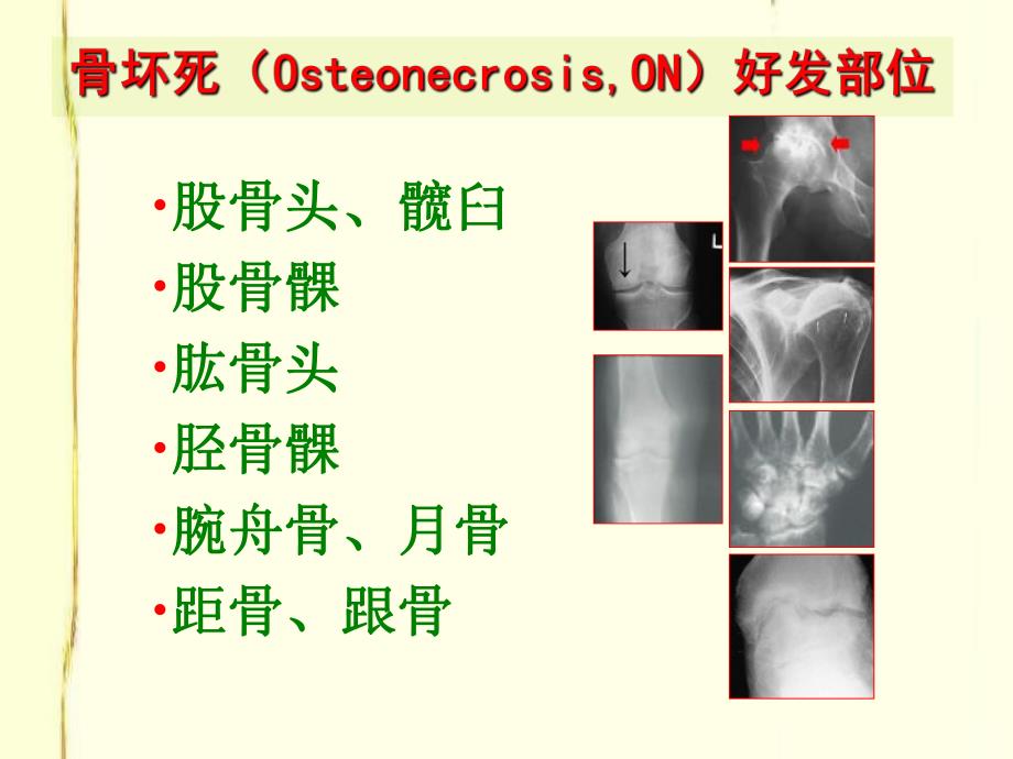 骨坏死的研究和治疗进展周江南.ppt_第3页