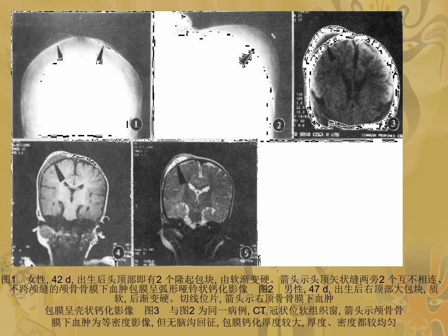 颅骨骨膜下血肿.ppt_第2页