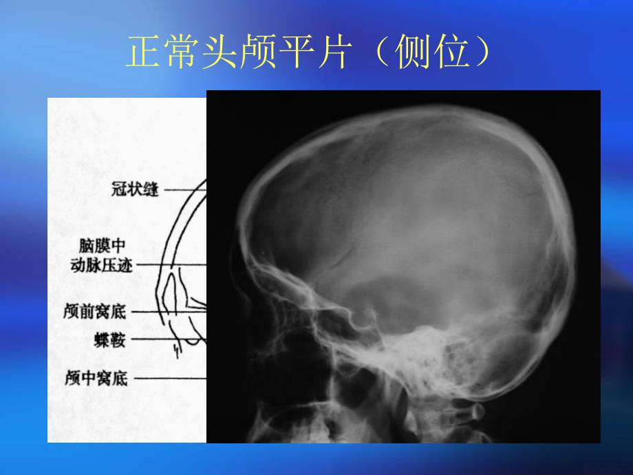 颅骨x线诊断.ppt_第1页