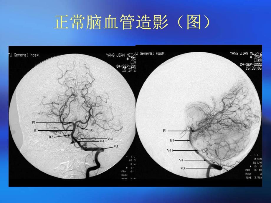 颅骨x线诊断.ppt_第3页