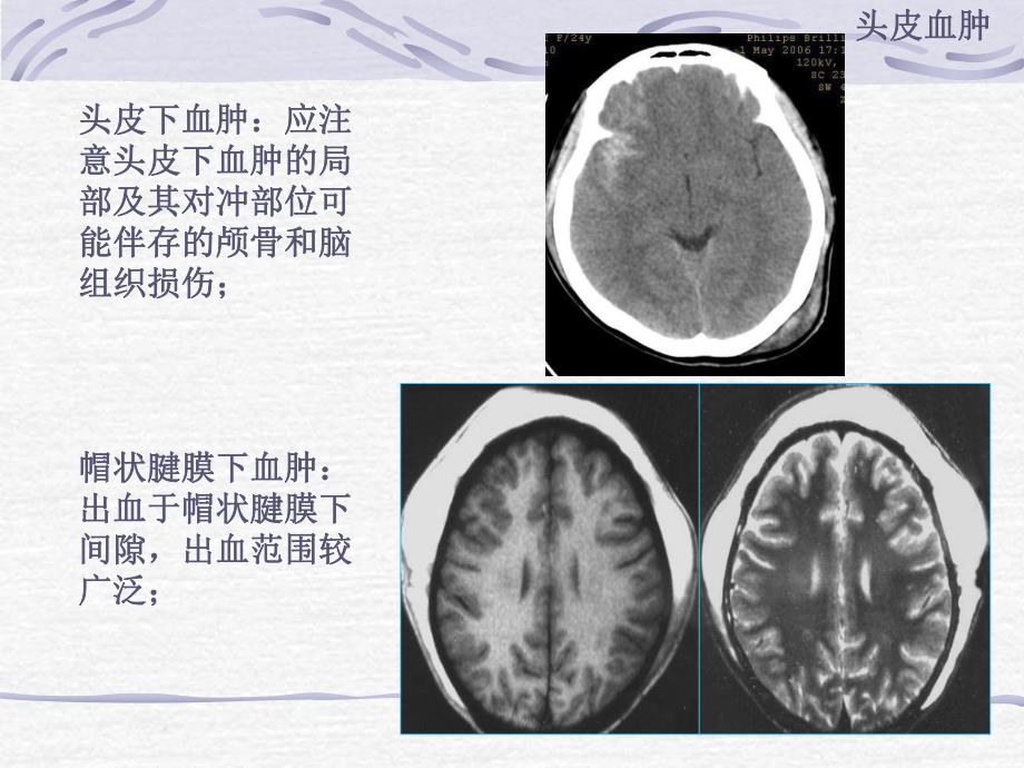 颅脑外伤的CT表现.ppt_第3页