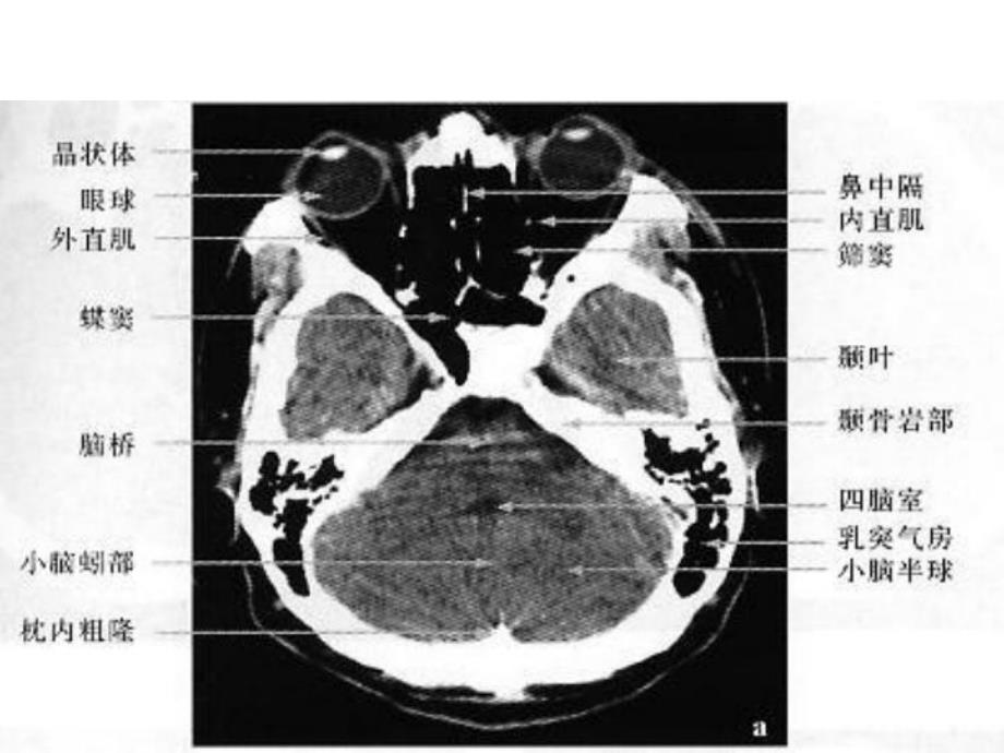 颅脑CTMRI解剖3.ppt_第2页