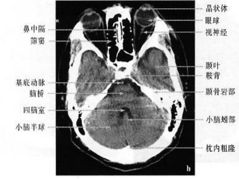 颅脑CTMRI解剖3.ppt_第3页