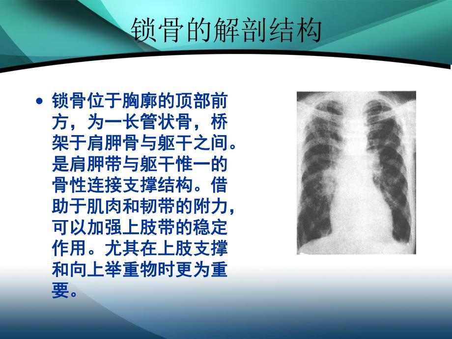 锁骨骨折的护理课件.ppt_第2页