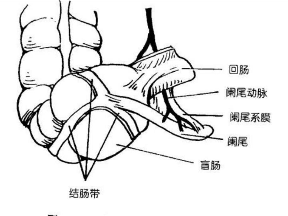 阑尾炎Acuteappendicitis.ppt_第3页