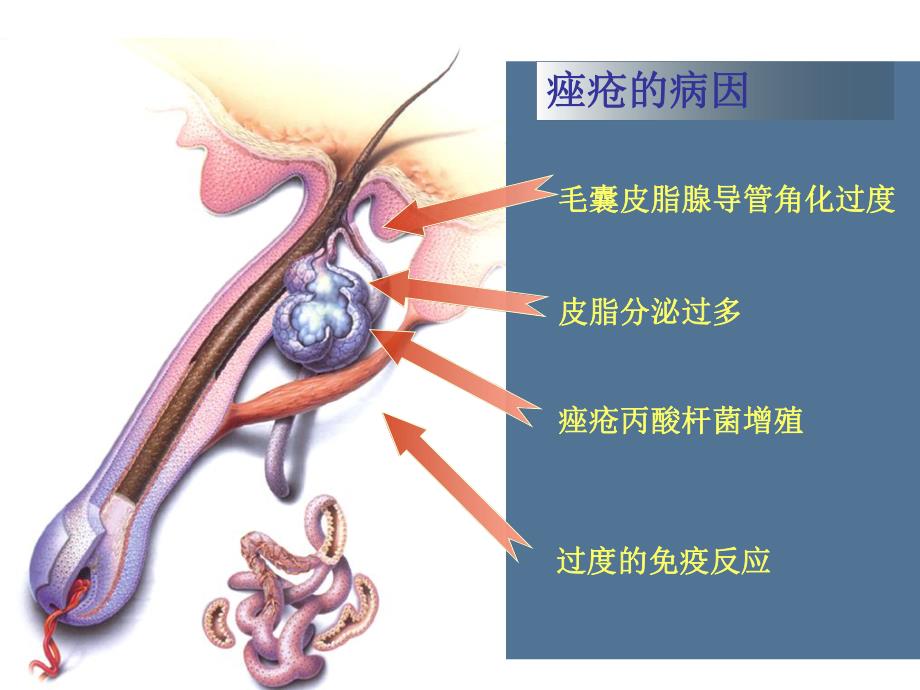 阿达帕林凝胶万全达文.ppt_第3页