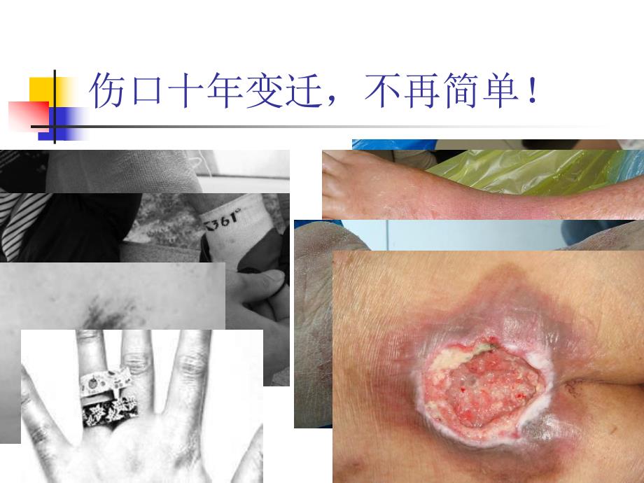 门诊伤口临床分类沈月宏.ppt_第3页