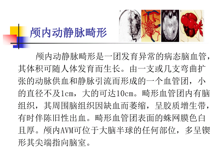 脑血管畸形诊治.ppt_第2页