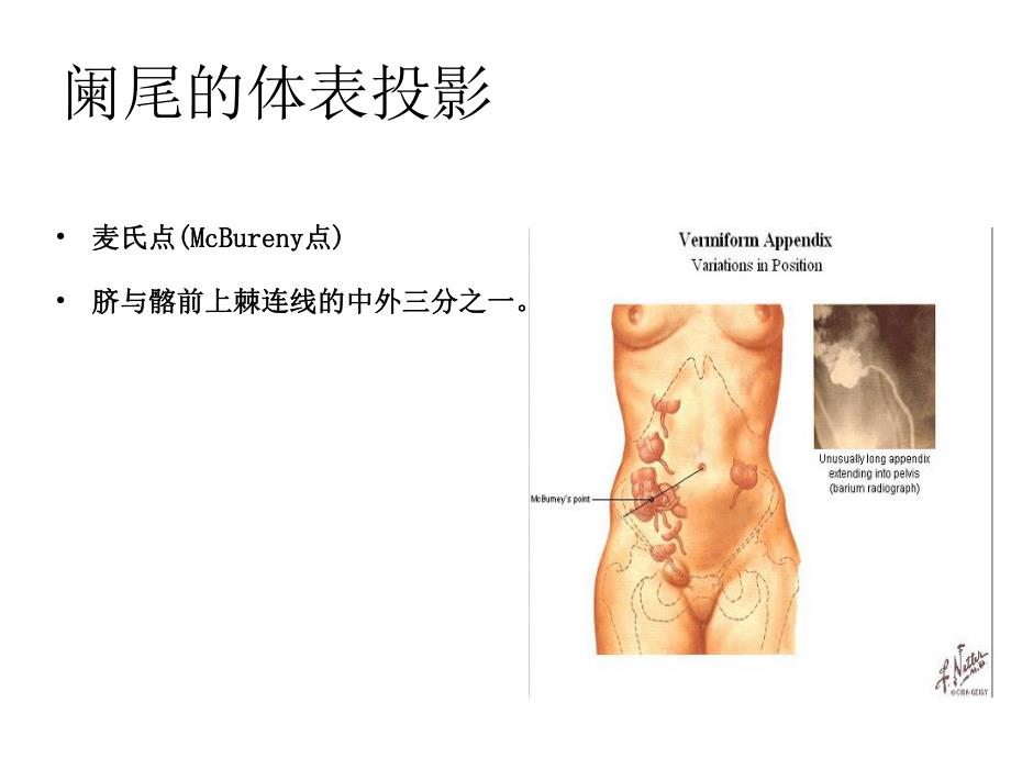 第三节急性阑尾炎病人的护理.ppt_第3页