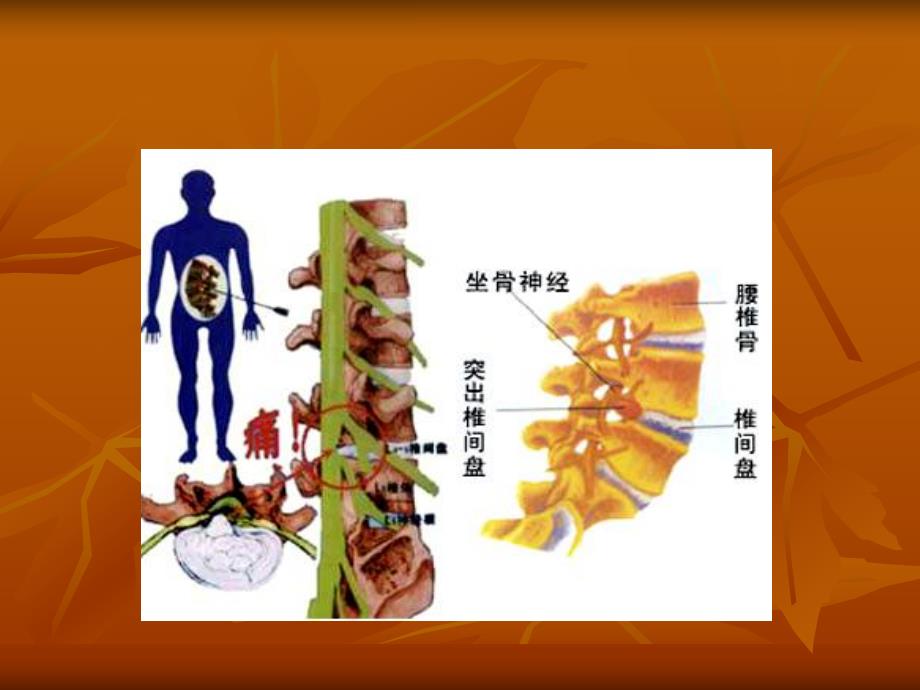 腰椎间盘突出症.ppt_第2页