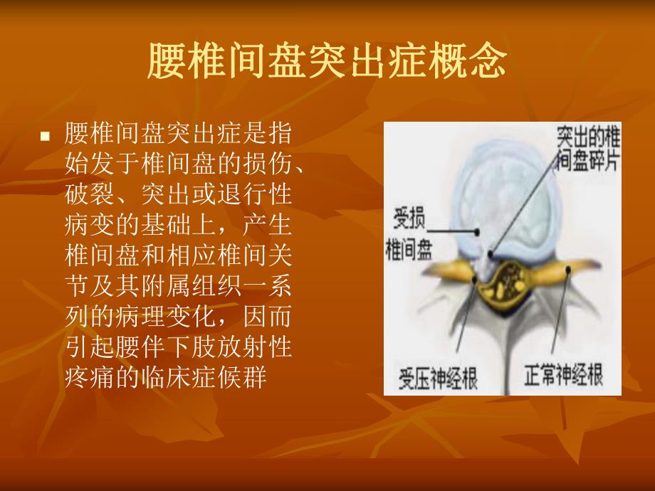 腰椎间盘突出症.ppt_第3页