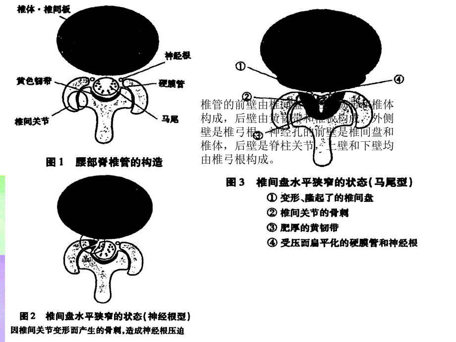 腰椎管狭窄症.ppt_第3页