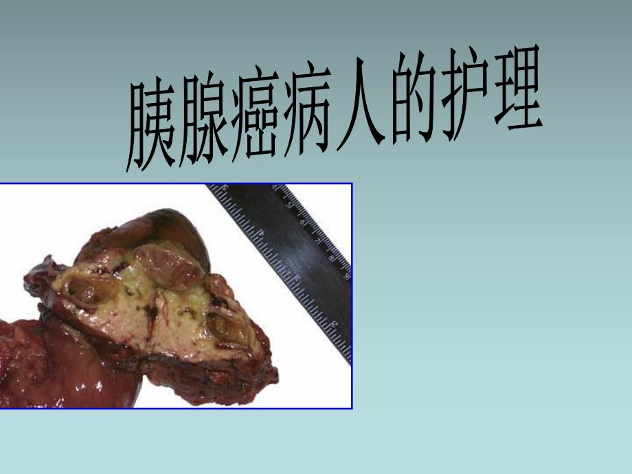 胰腺癌病人的护理.ppt_第1页