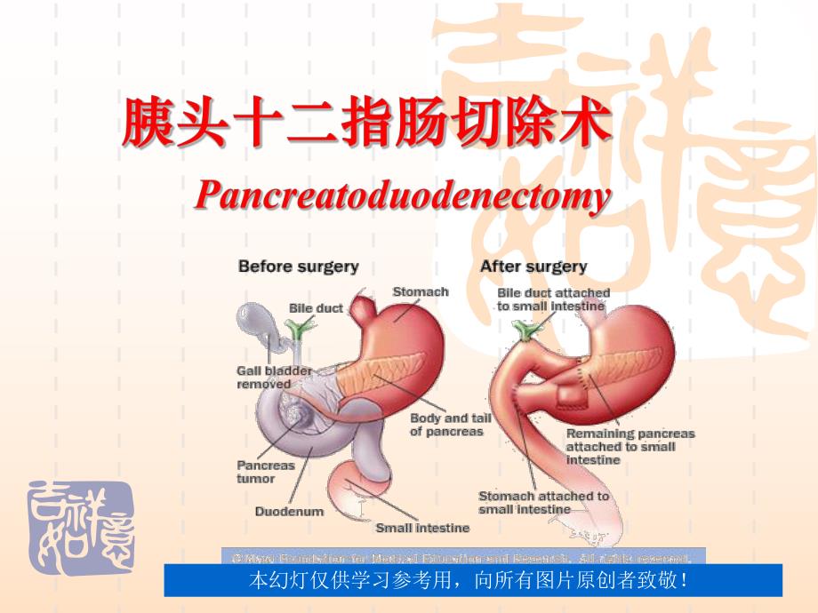 胰十二指肠切除术.ppt_第1页