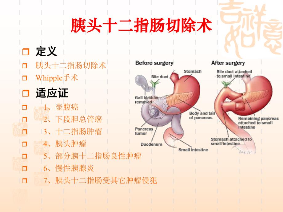 胰十二指肠切除术.ppt_第2页