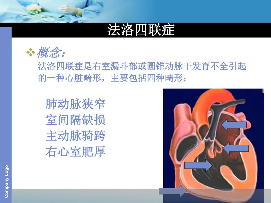 tof法洛四联症ppt课件.ppt_第2页