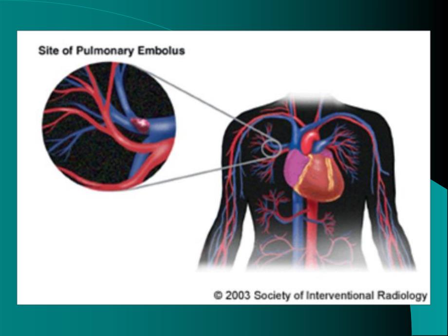 肺栓塞护理查房.ppt_第3页