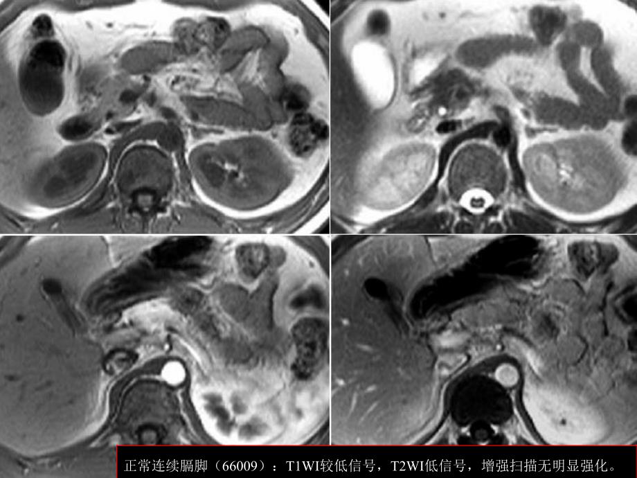 膈角CTMRI表现及常见变异王俭.ppt_第3页
