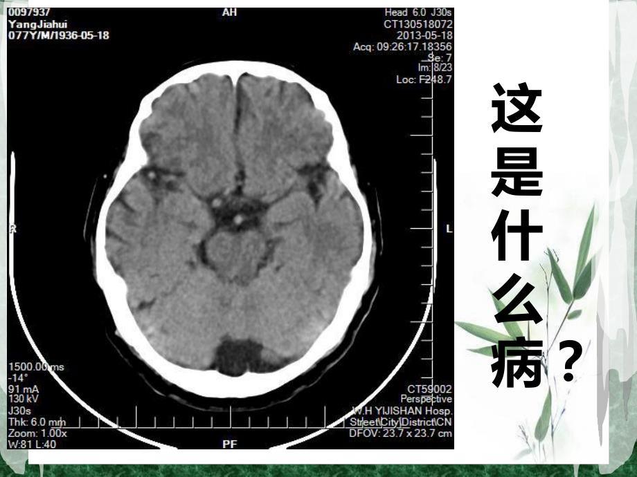 蛛网膜囊肿2.ppt_第2页