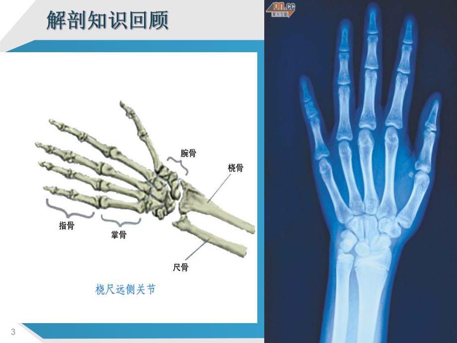 多指畸形.ppt_第3页