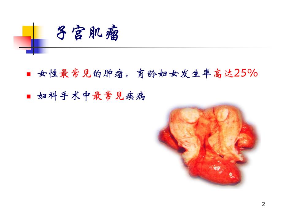 子宫肌瘤北京协和医院.ppt_第2页