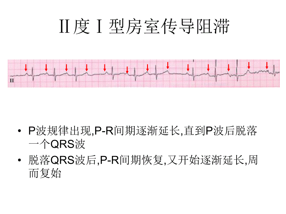 心律失常与心电图4.ppt_第3页