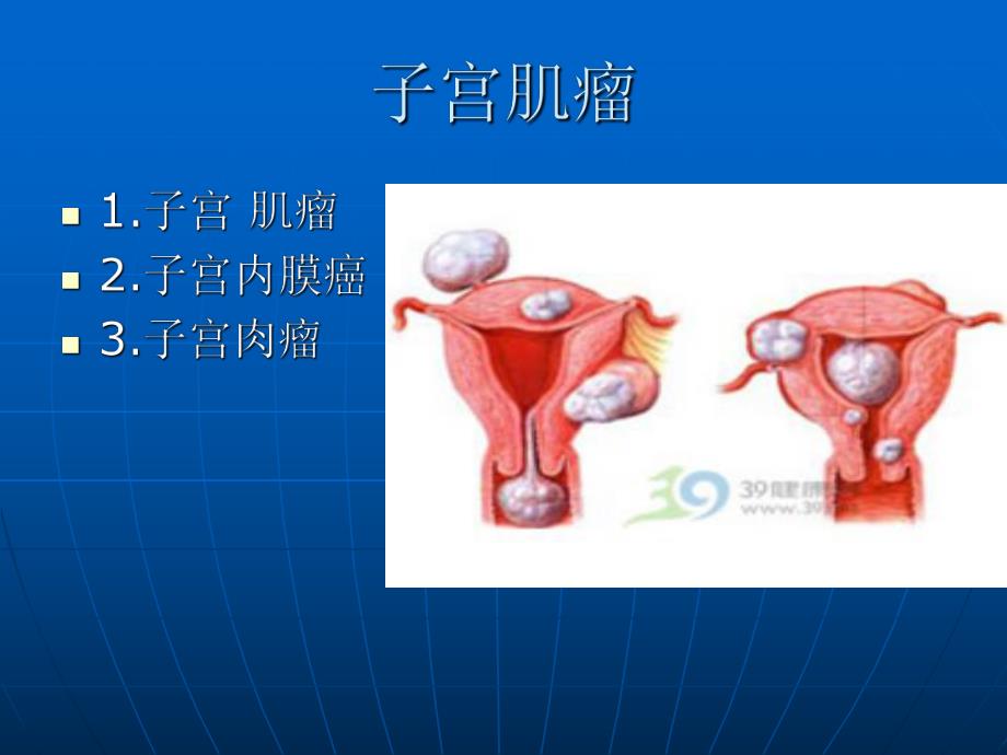 子宫肌瘤病人的护理PPT.ppt_第3页