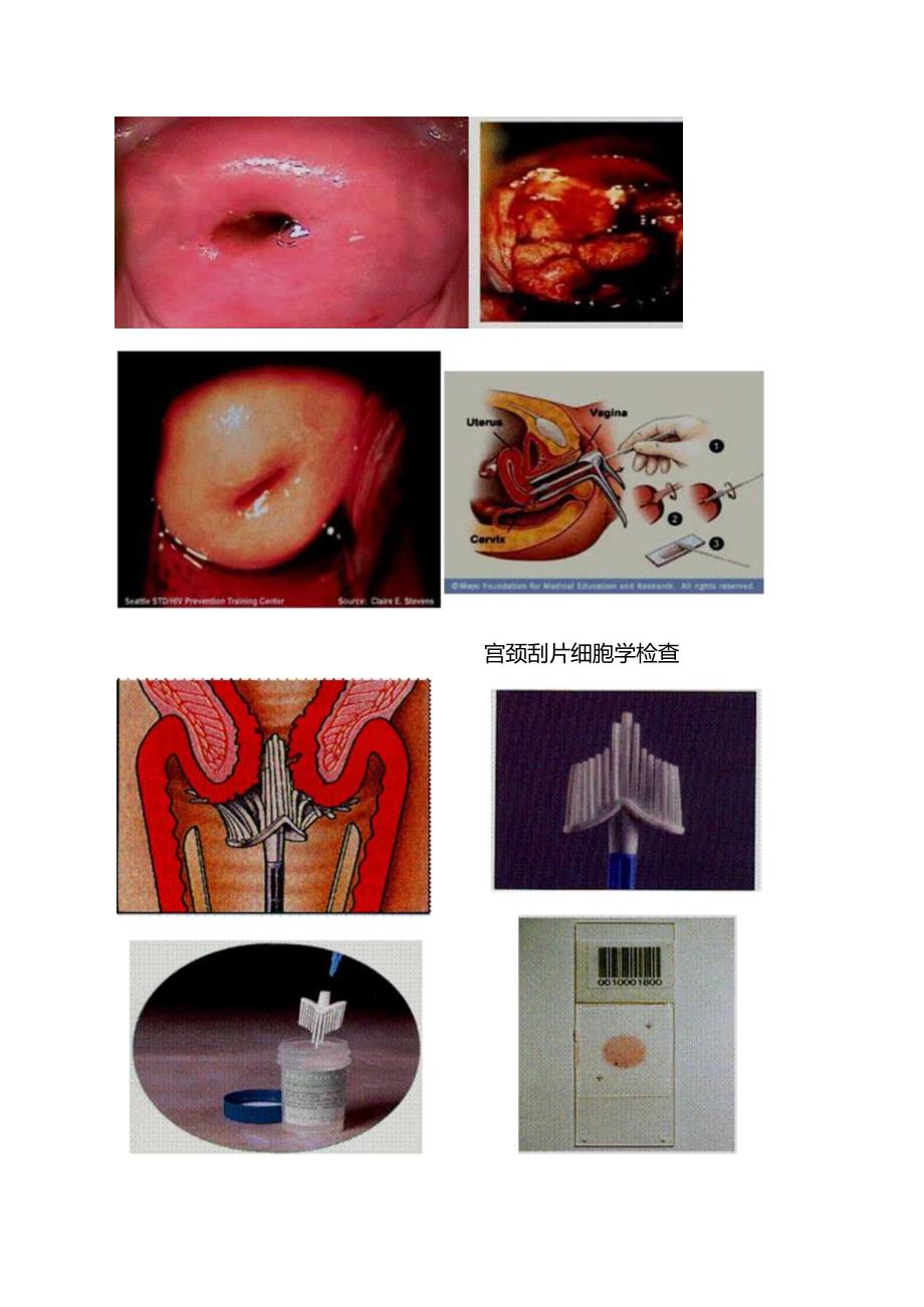 中西医结合妇科学-女性生殖器官肿瘤课程讲义及练习.docx_第2页