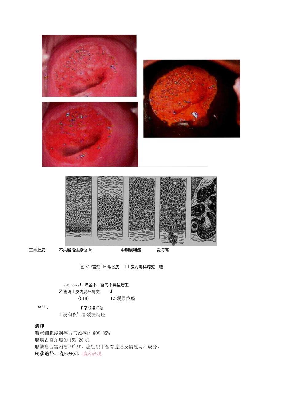 中西医结合妇科学-女性生殖器官肿瘤课程讲义及练习.docx_第3页