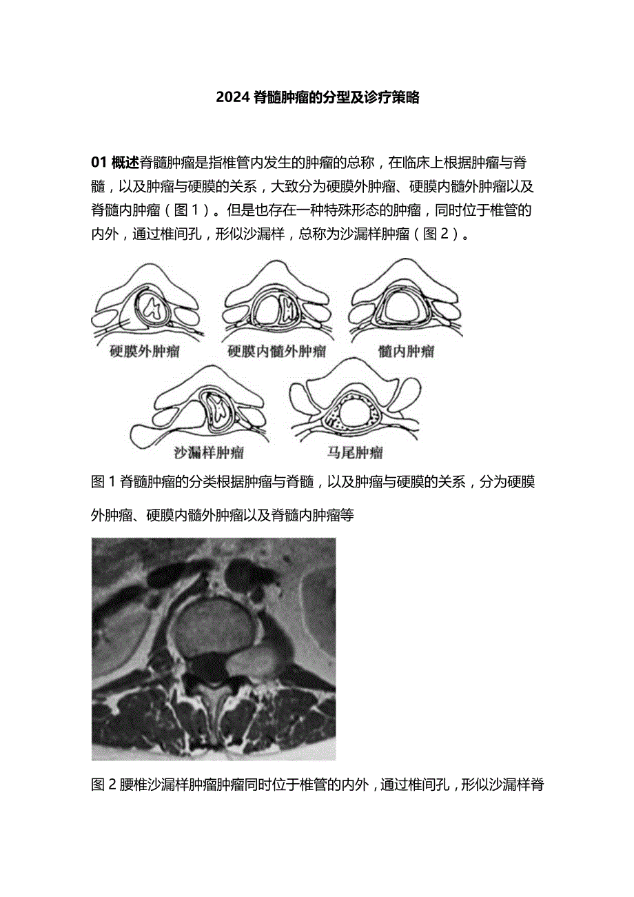 2024脊髓肿瘤的分型及诊疗策略.docx_第1页