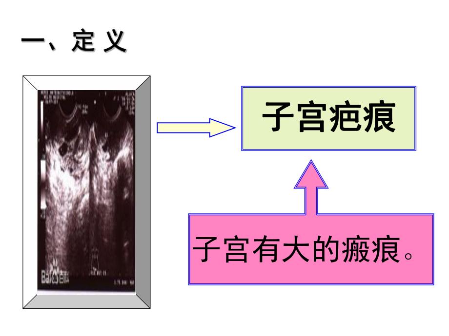 疤痕子宫再次妊娠有关问题的探讨.ppt_第3页