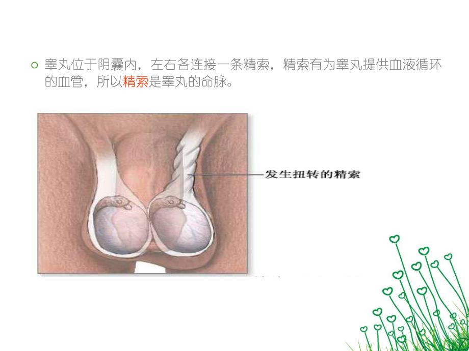 睾丸扭转医学ppt.ppt_第3页