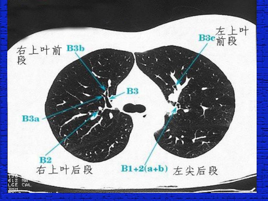 [医药卫生]肺段支气管CT读片.ppt_第3页