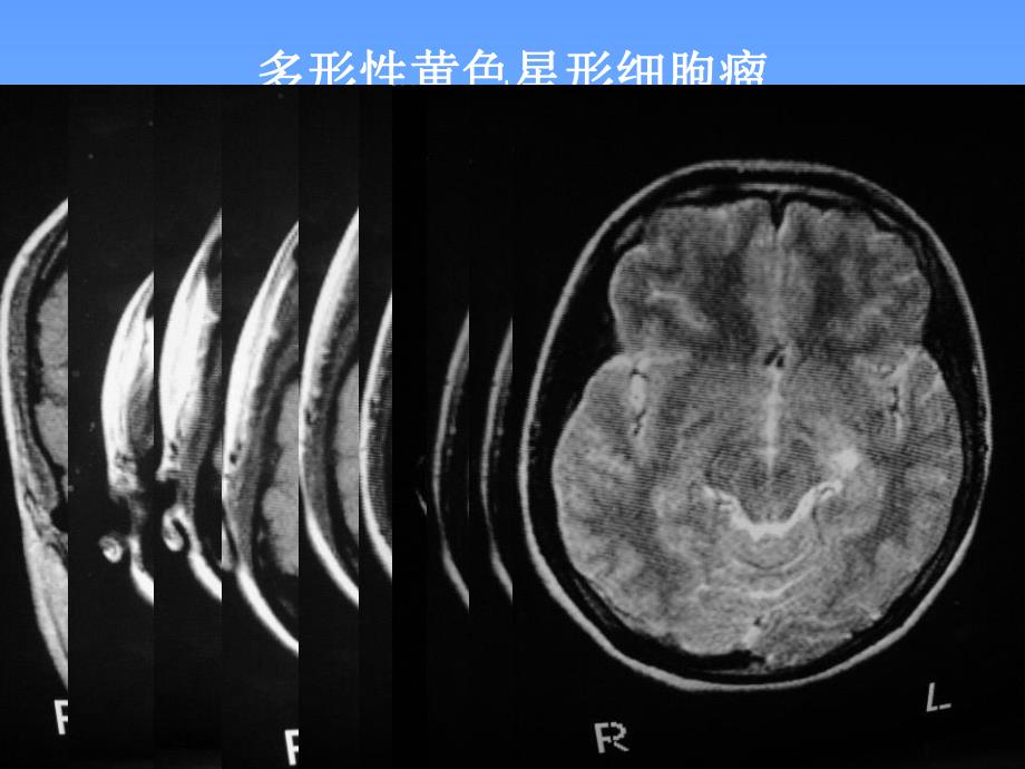 CNS疾病MRI诊断.ppt_第2页