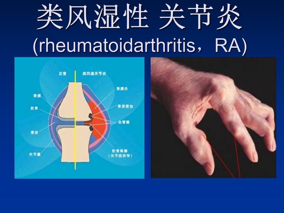 35类风湿性关节炎.ppt_第1页