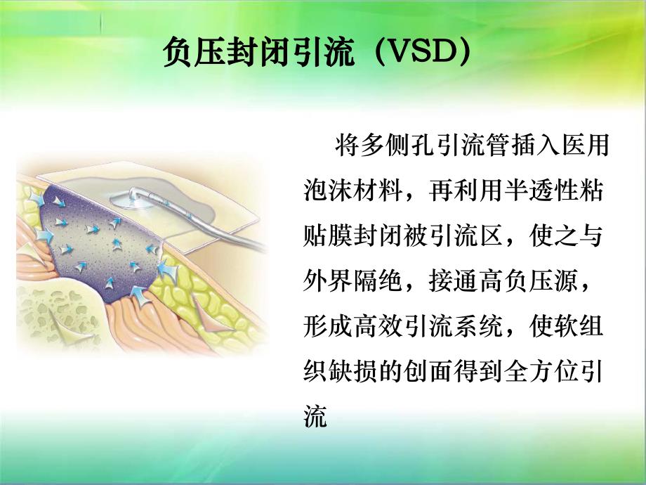 VSD的机制及相关护理.ppt_第2页